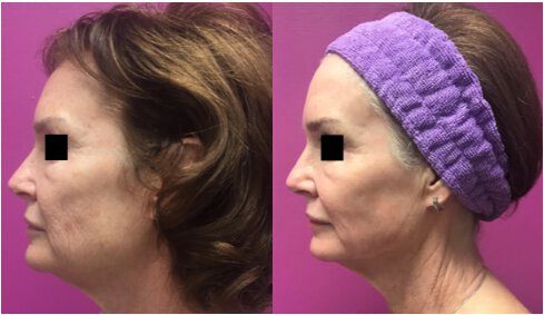 Laser Skin Resurfacing before and after