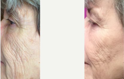 Laser Skin Resurfacing before and after