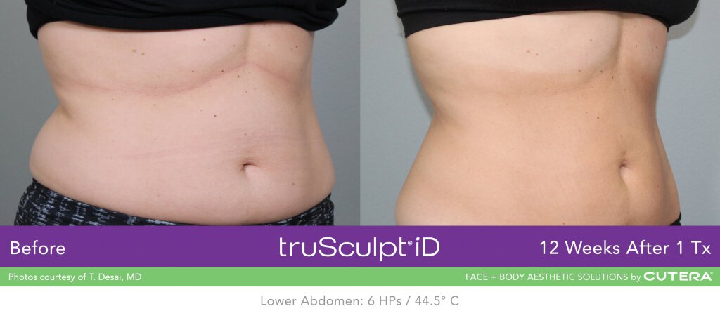 truSculpt 3D