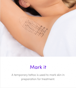 miradry infographic - mark it - a temporary tattoo is used to mark skin in preperation for treatment