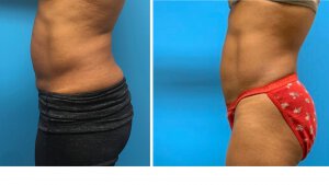 Body Sculpting before and after