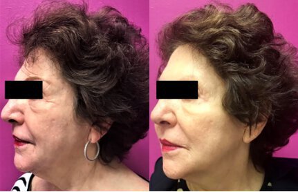 Laser Skin Resurfacing before and after