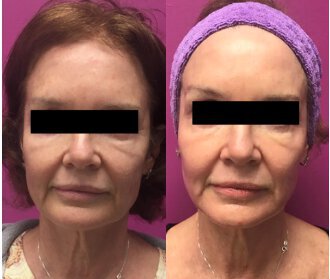 Laser Skin Resurfacing before and after