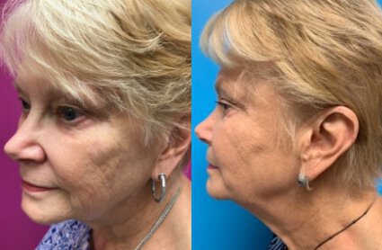 Laser Skin Resurfacing before and after