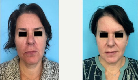 Laser Skin Resurfacing before and after