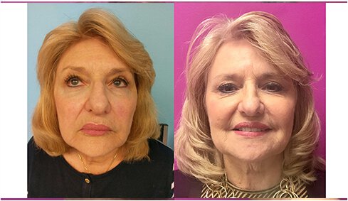 Laser Skin Resurfacing before and after