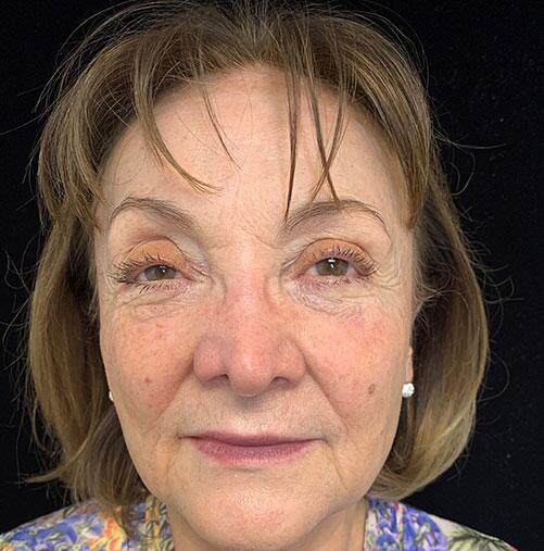 Botox & Fillers Before & After Image