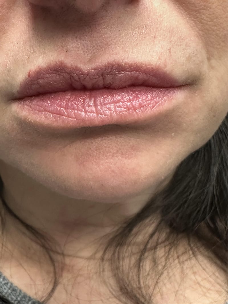 Botox dermal fillers Before & After Image