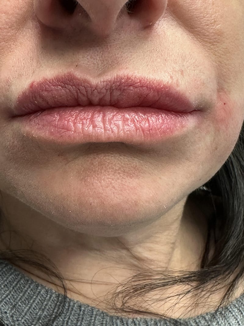 Botox dermal fillers Before & After Image