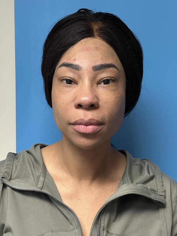 Dermal Fillers Before & After Image