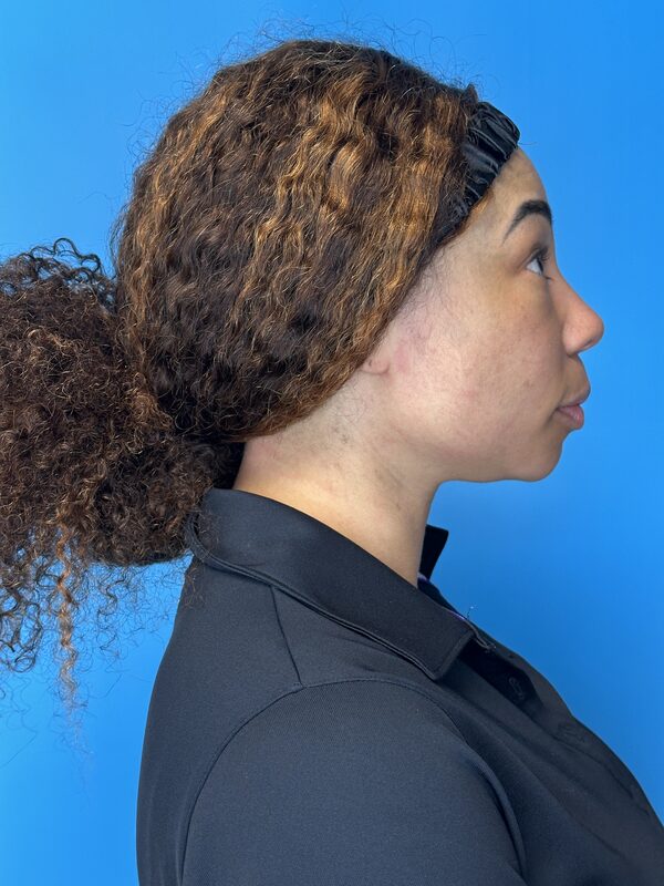 Dermal Fillers Before & After Image