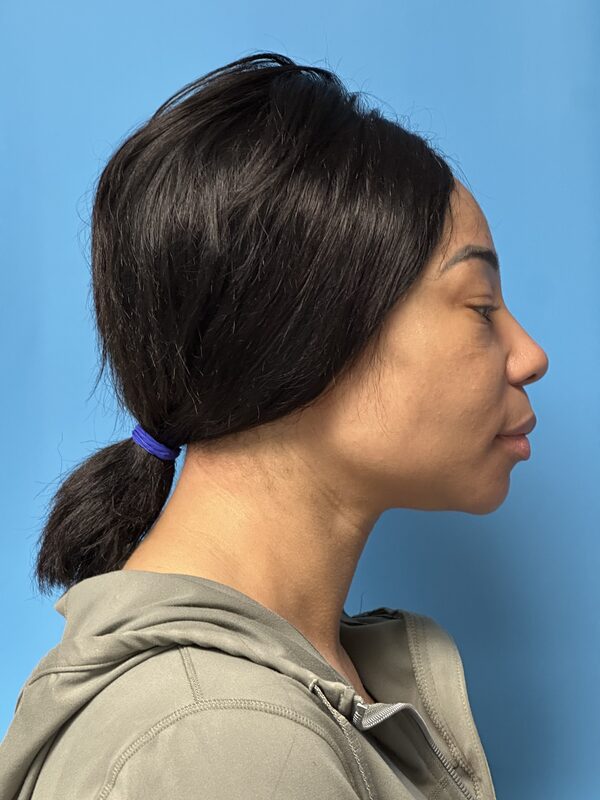 Dermal Fillers Before & After Image
