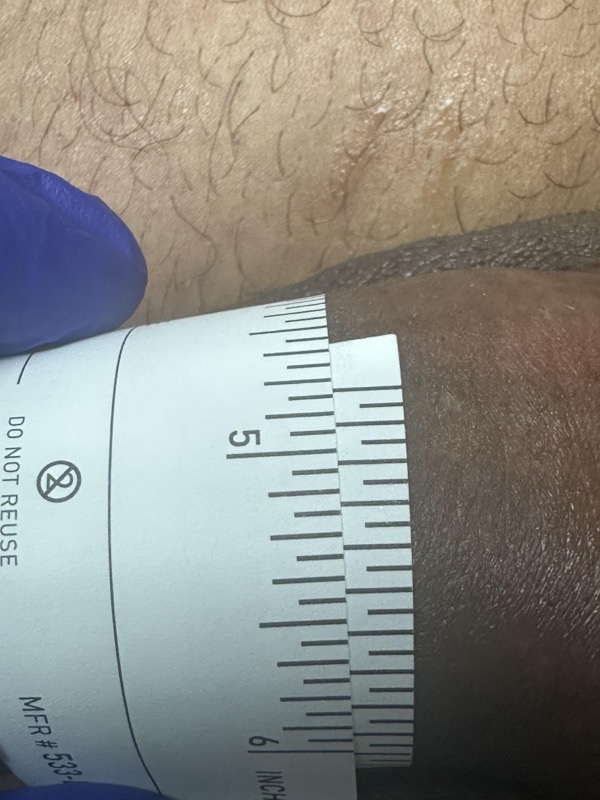 Mojo Max | Penile Enhancement Before & After Image