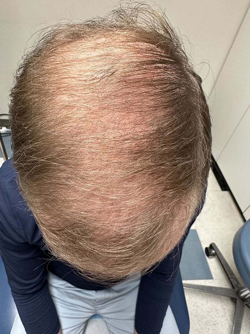 Hair Loss Treatment Before & After Image