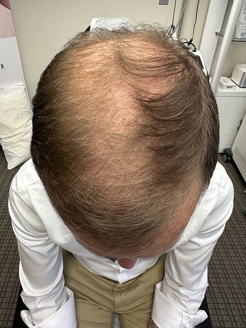 Hair Loss Treatment Before & After Image