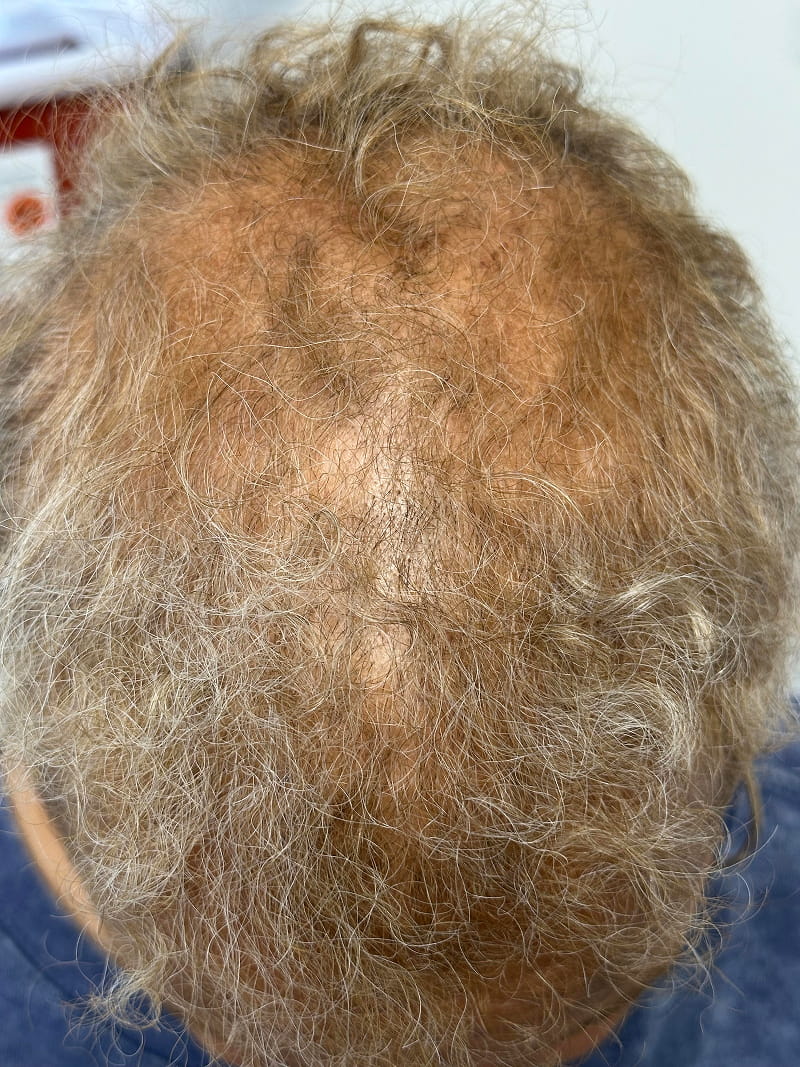 Hair Loss Treatment Before & After Image