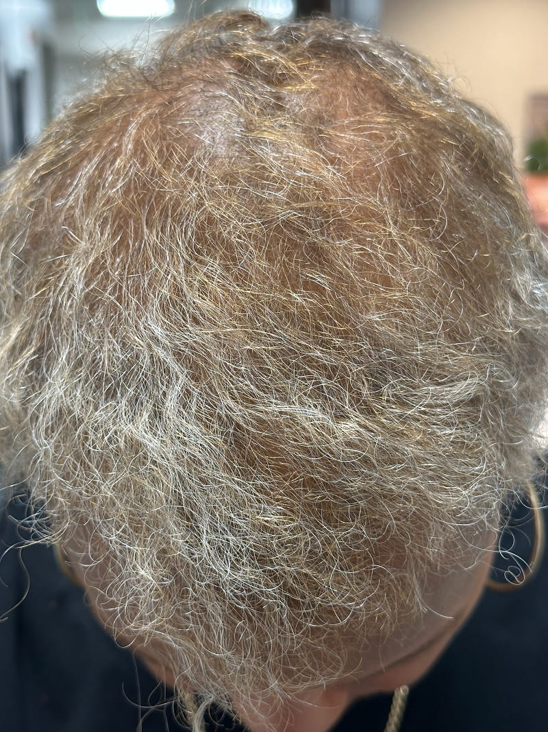 Hair Loss Treatment Before & After Image