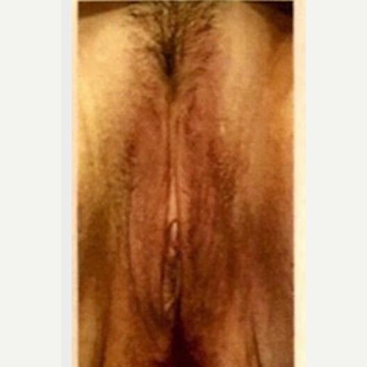Labiaplasty Before & After Image