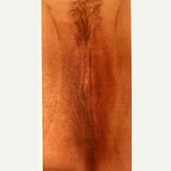 Labiaplasty Before & After Image